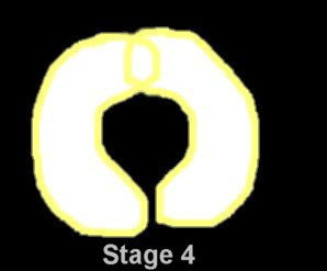 stage4