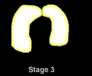 stage3